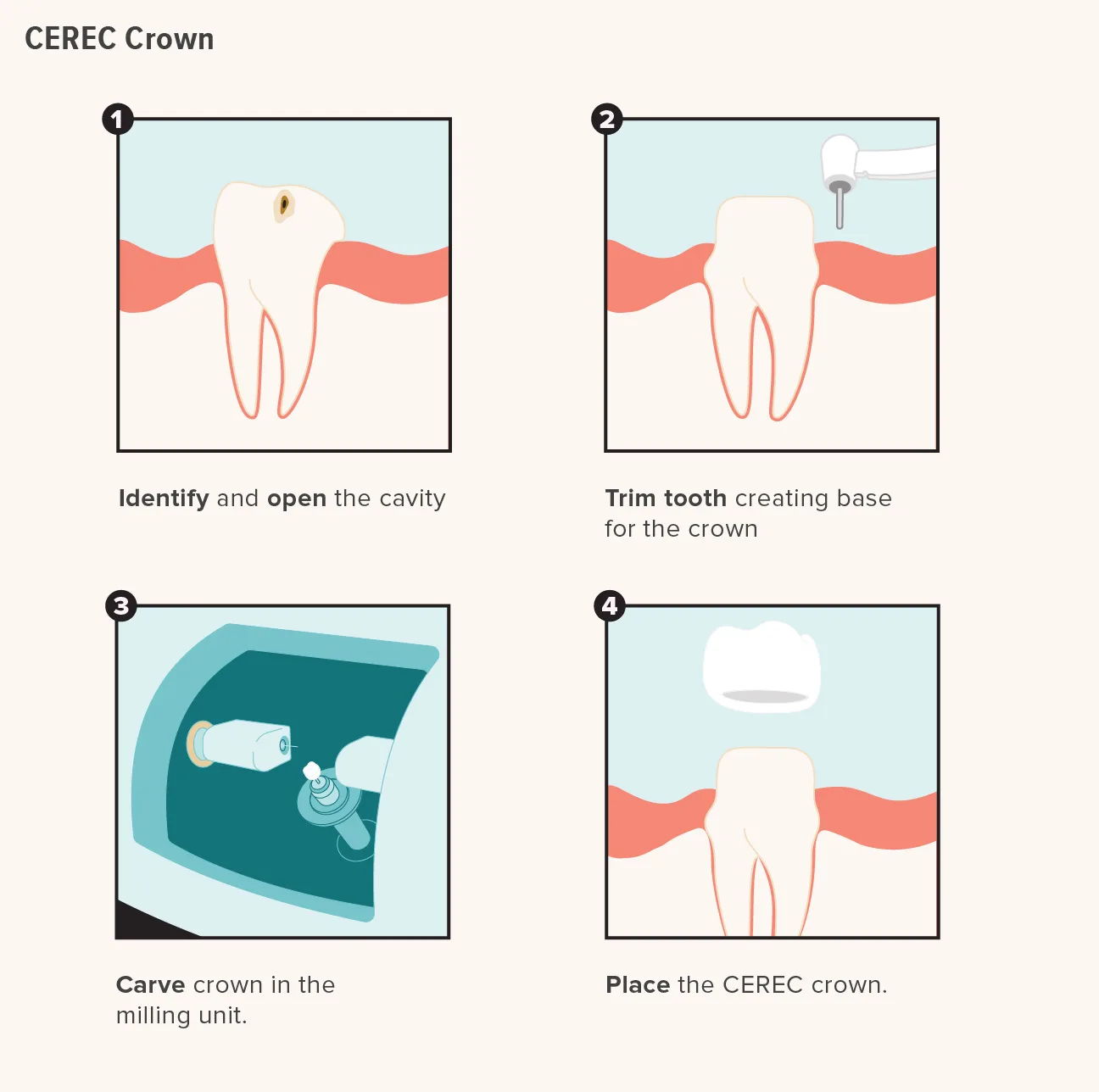 CEREC dental crown created with computer-assisted design at Mathee Dental Studio, Somerset West